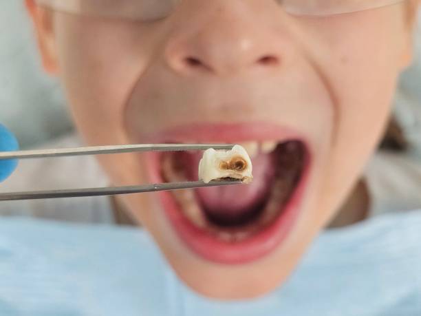 Best Root Canal Emergency Dentist  in Navarre Beach, FL